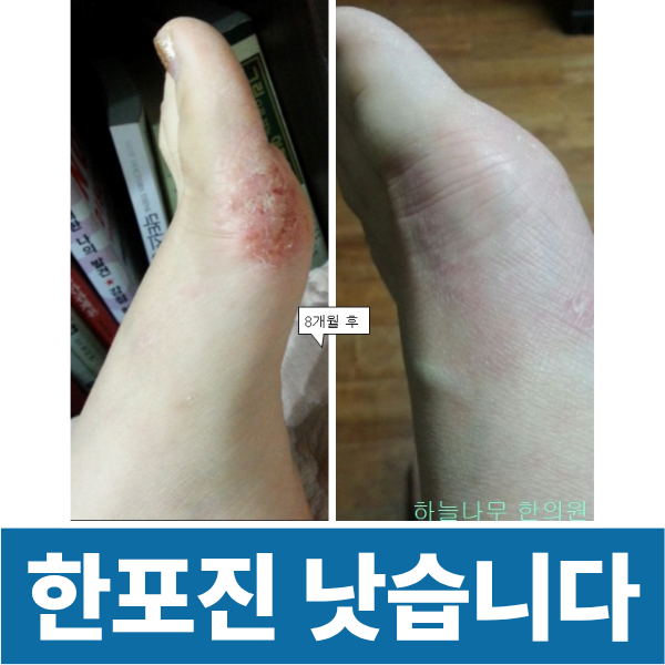 진물과 통증을 동반하는 한포진도 잠실나무한의원으로 오세요