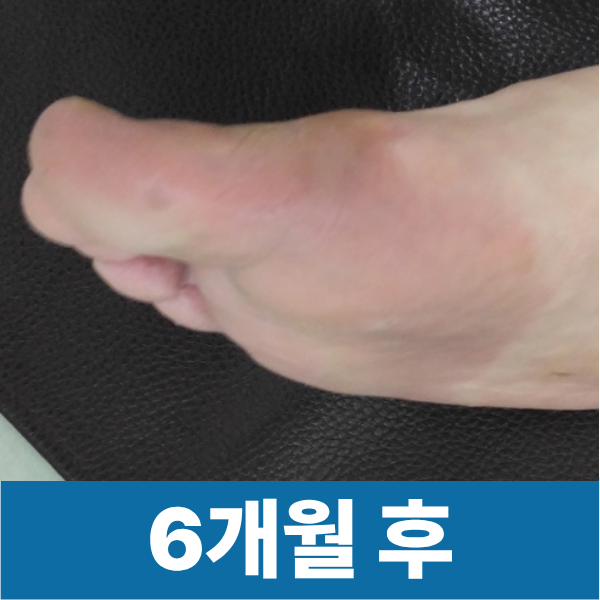 한포진 환자 6개월 후 경과사진입니다 말끔하게 나았습니다