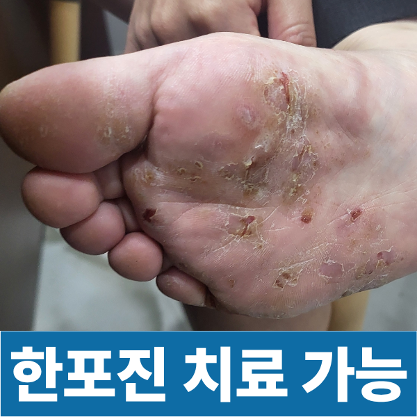 고생하시는 한포진 피부병도 어렵지않게 치료가능합니다