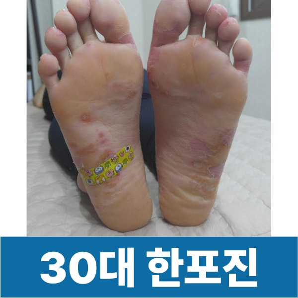 30대 한포진 환자 발 사진 입니다 가운데 쪽에 포진이 올라와있어요