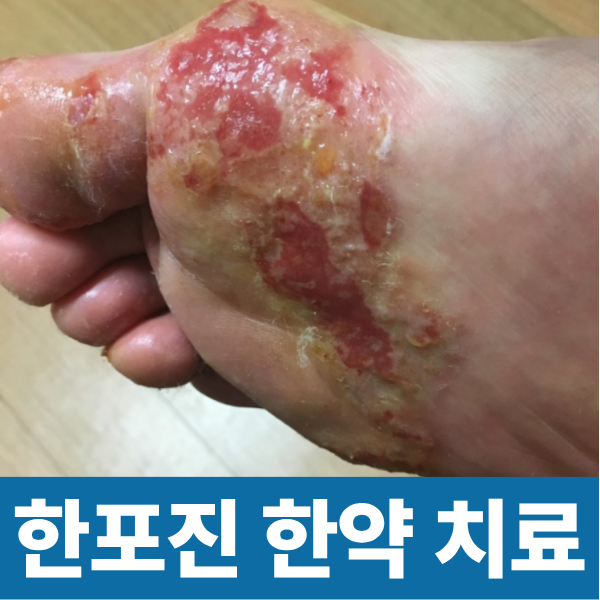 한포진 한약으로 치료 가능합니다 잠실나무한의원입니다